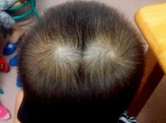 xoáy tóc, xoáy đầu