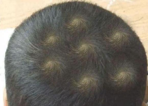 xoáy tóc, xoáy đầu